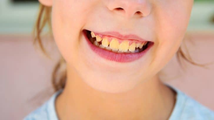 What to Do With Your Kids Yellow Teeth?