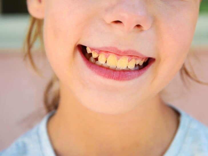 What to Do With Your Kids Yellow Teeth?