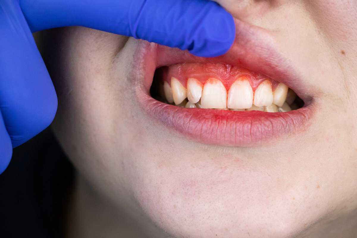 When Does Teeth Sensitivity Start In Pregnancy?
