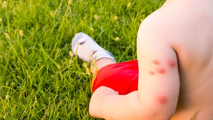 Dealing With Mosquito Bites On Babies – The Complete Guide To Avoid The Fuss