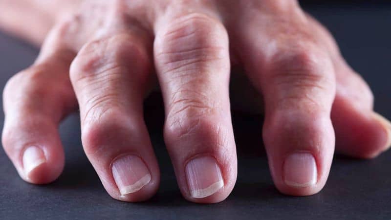 Cracking Knuckles Causes Arthritis