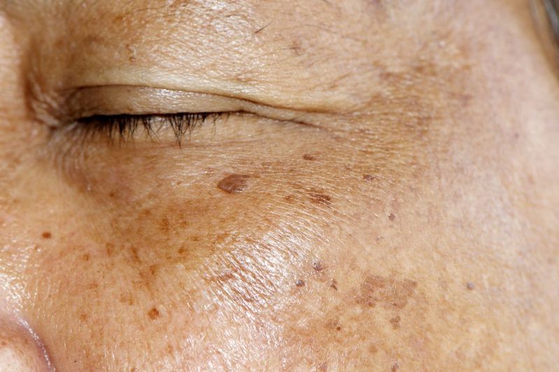 Age Spots
