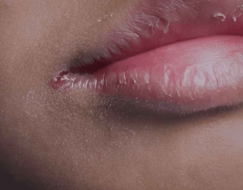 Cracked Corners of the Mouth