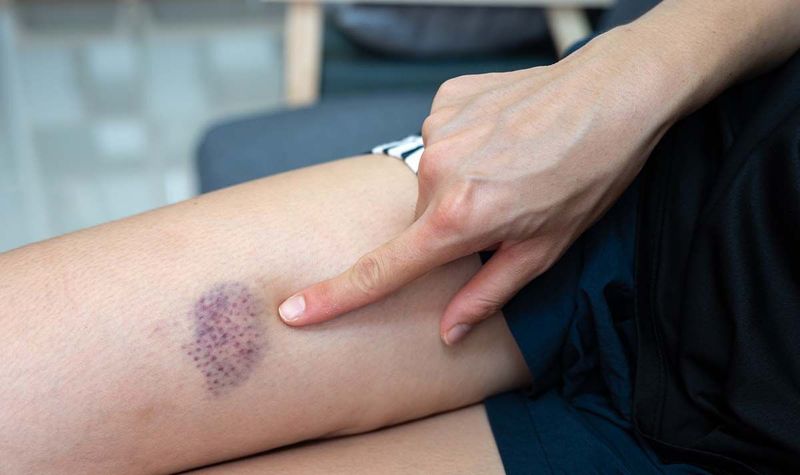 Easy Bruising