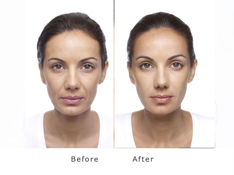 Facial Volume Loss