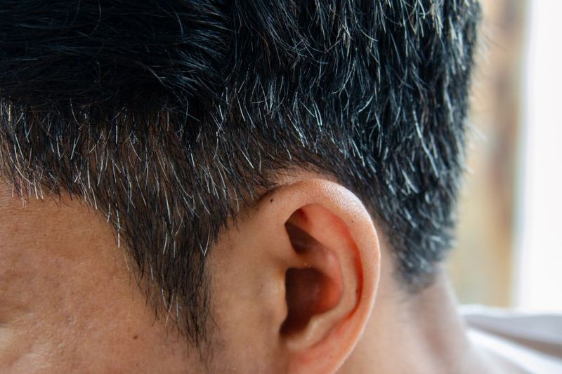 Premature Graying of Hair