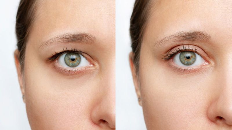 Sagging Eyelids and Under-Eye Bags