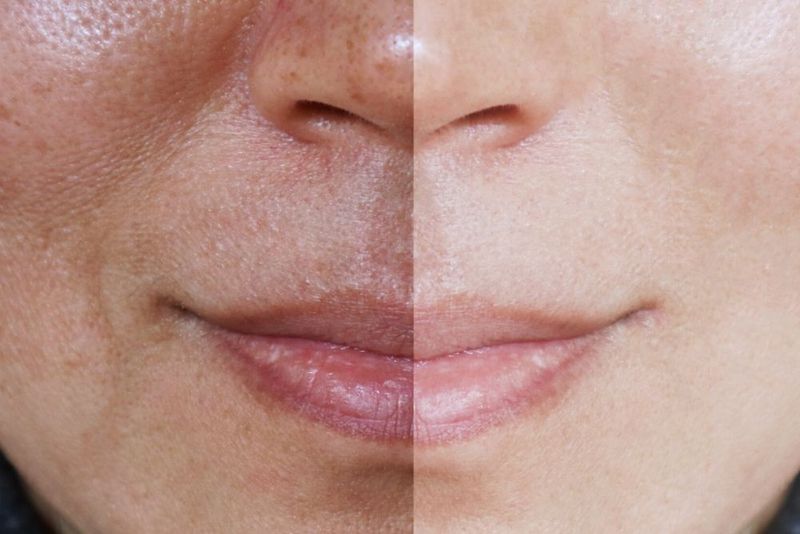 Uneven Complexion