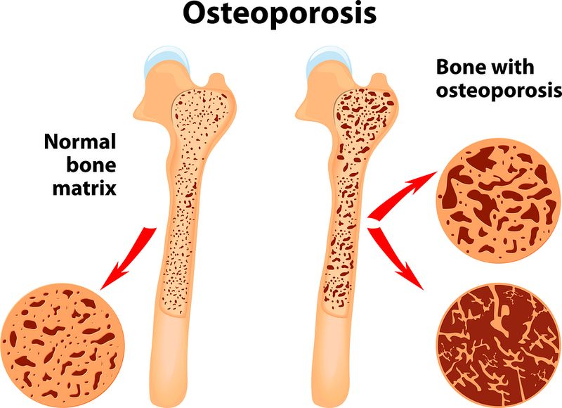 Osteoporosis