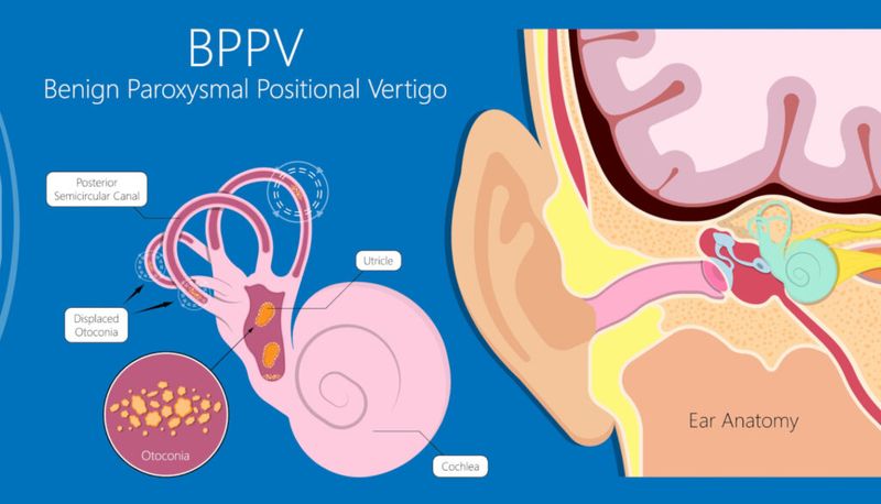 Benign Paroxysmal Positional Vertigo (BPPV)