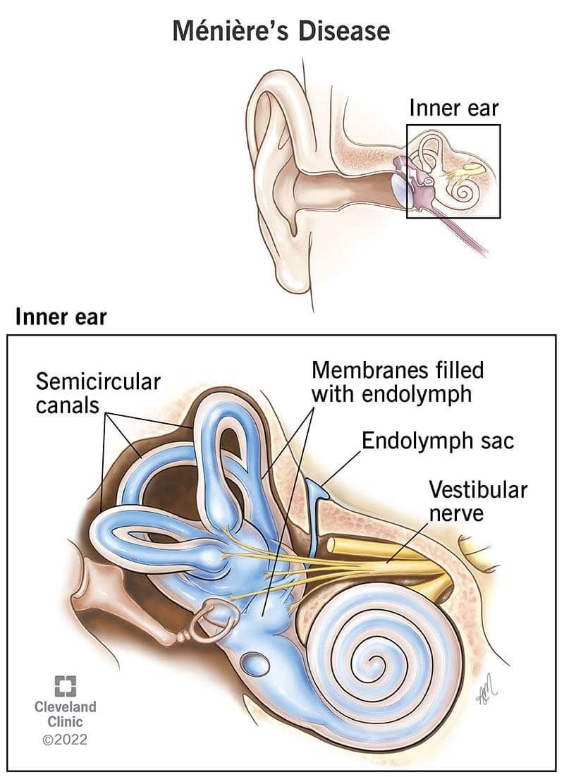 Meniere's Disease