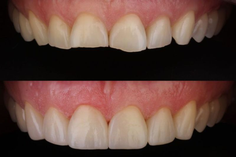 Teeth Grinding