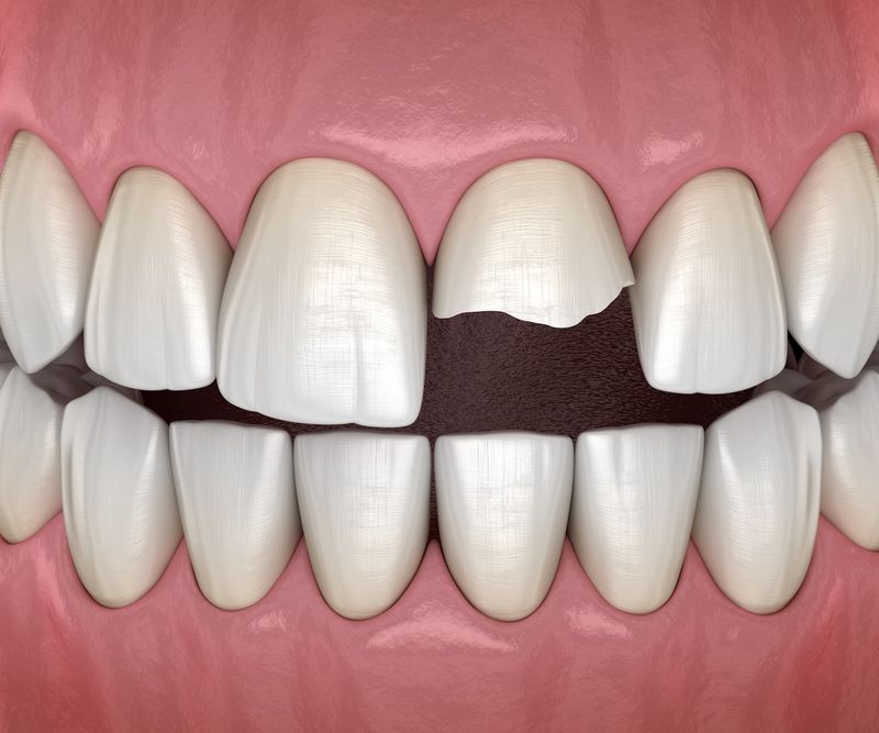 Chipped Teeth