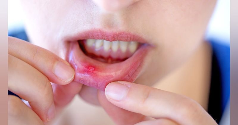 Oral Sores