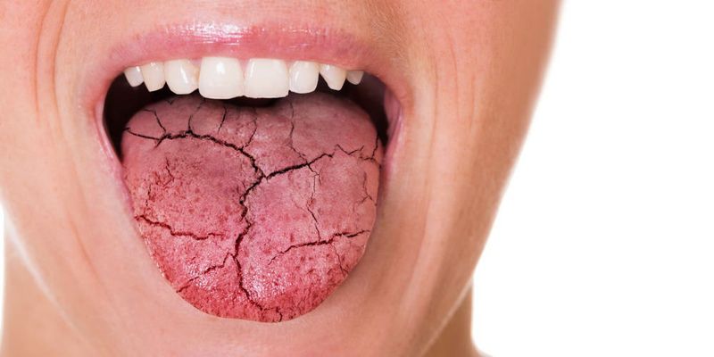 Dry Mouth