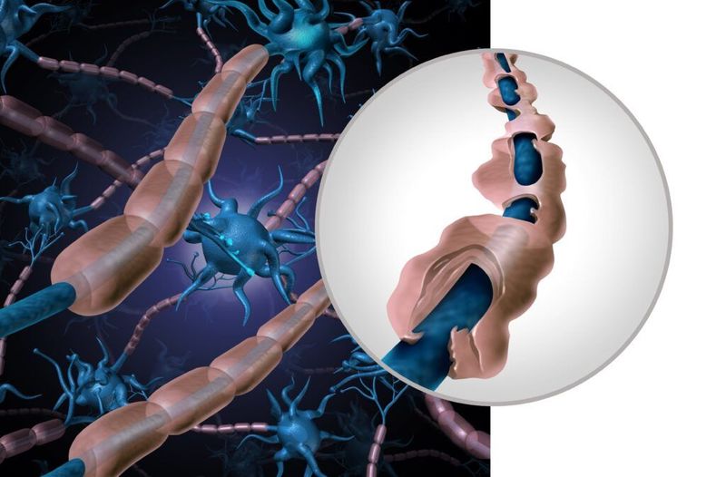 Multiple Sclerosis Support