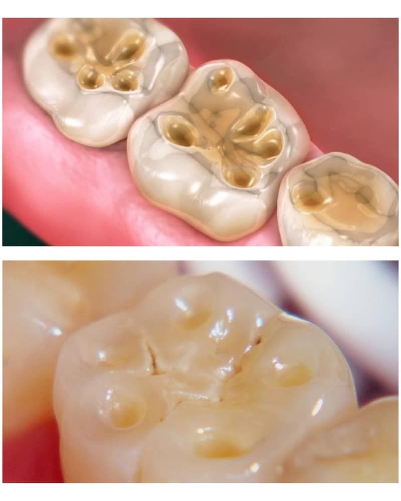 Enamel Erosion