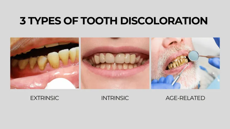 Tooth Discoloration