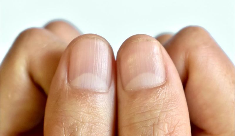 Nail Condition