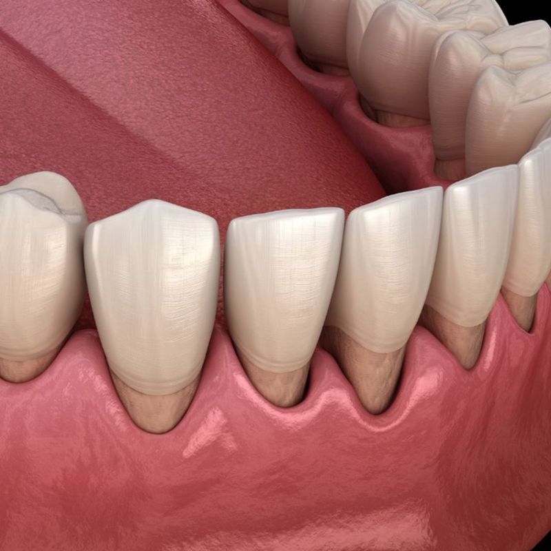 Gum Recession